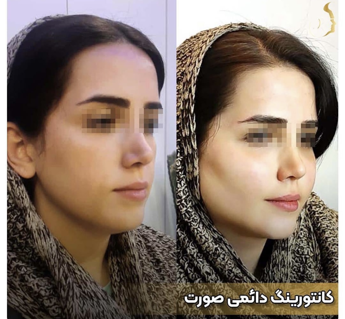 تزریق ژل