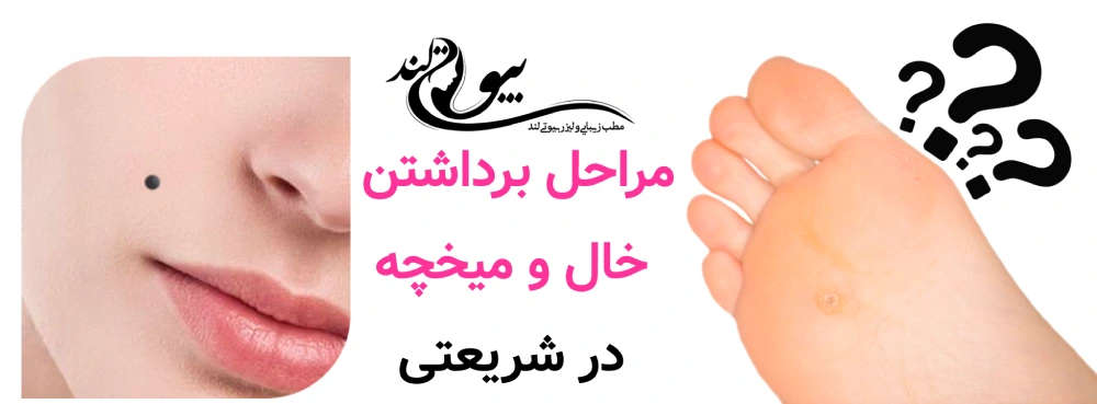 مراحل برداشتن خال و میخچه در شریعتی 