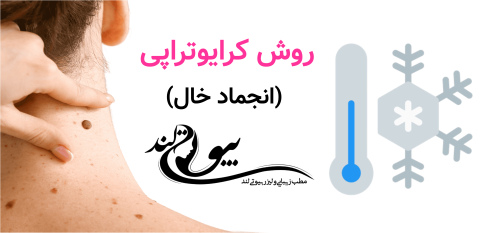 روش کرایوتراپی (انجماد خال)