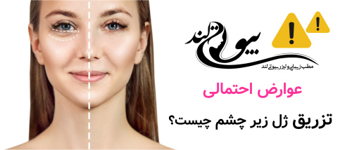 عوارض احتمالی تزریق ژل زیر چشم چیست؟