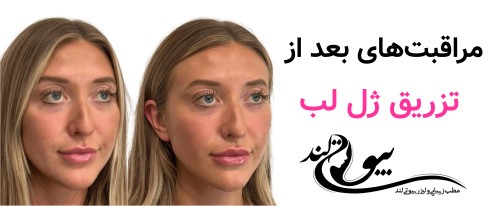 مراقبت‌های بعد از تزریق ژل لب