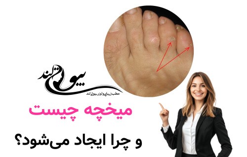 میخچه چیست و چرا ایجاد می‌شود؟