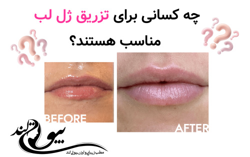 چه کسانی برای تزریق ژل لب مناسب هستند؟