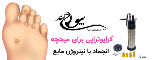 کرایوتراپی برای میخچه؛ انجماد با نیتروژن مایع