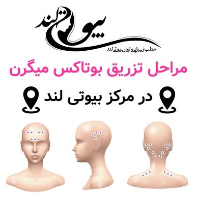 مراحل تزریق بوتاکس میگرن در مرکز بیوتی لند