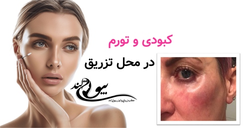 کبودی و تورم در محل تزریق