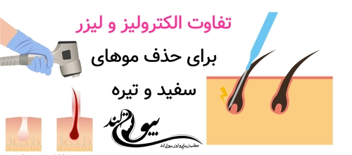 تفاوت الکترولیز و لیزر برای حذف موهای سفید و تیره
