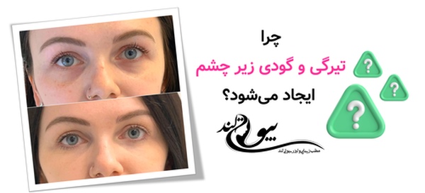 چرا تیرگی و گودی زیر چشم ایجاد می‌شود؟