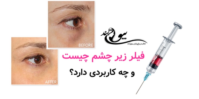 فیلر زیر چشم چیست و چه کاربردی دارد؟