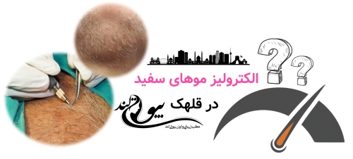 الکترولیز موهای سفید در قلهک
