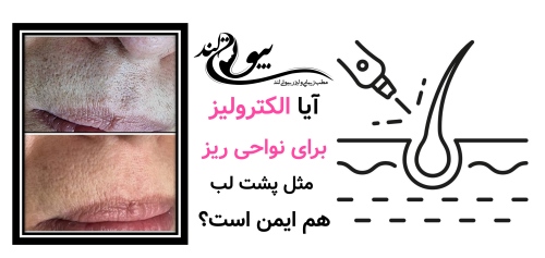 آیا الکترولیز برای نواحی ریز مثل پشت لب هم ایمن است؟