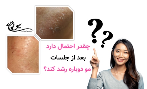 چقدر احتمال دارد بعد از جلسات مو دوباره رشد کند؟
