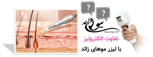 تفاوت الکترولیز با لیزر موهای زائد