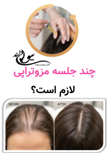 هزینه مزوتراپی مو | واقعاً چقدر باید برای درمان ریزش مو پرداخت کنیم؟ چند جلسه مزوتراپی لازم است و این روی هزینه چطور اثر می‌گذارد؟