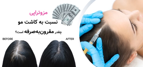 مزوتراپی نسبت به کاشت مو چقدر مقرون‌به‌صرفه است؟
