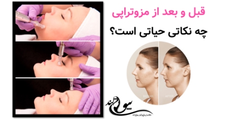 قبل و بعد از مزوتراپی چه نکاتی حیاتی است؟