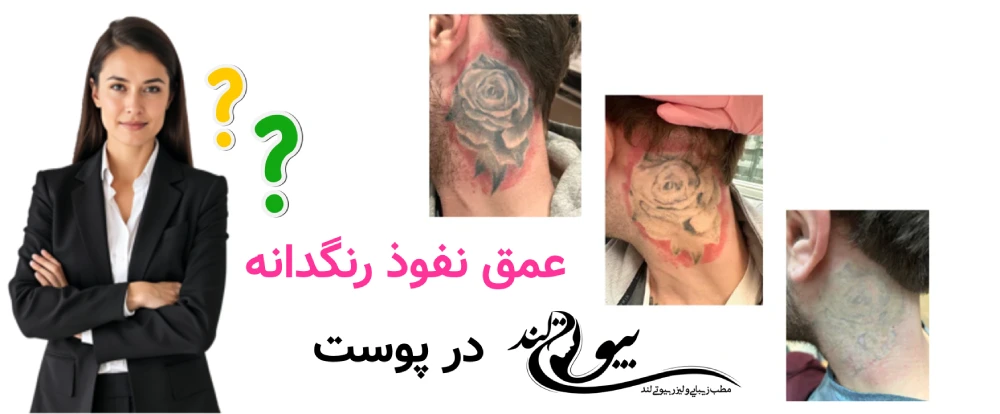پاک کردن تاتوهای قدیمی و رنگی عمق نفوذ رنگدانه در پوست
