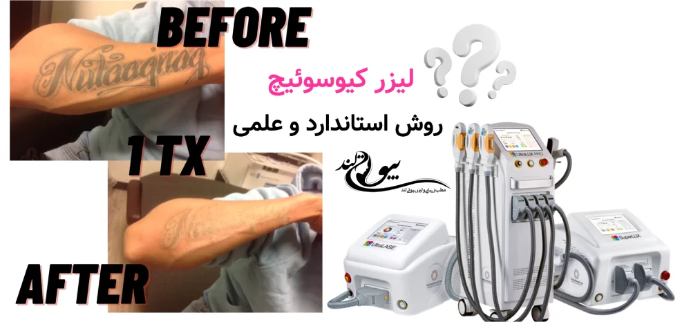 بهترین روش پاک کردن تاتو ابرو، بدن و لب؛ مقایسه علمی روش‌ها لیزر کیوسوئیچ – روش استاندارد و علمی