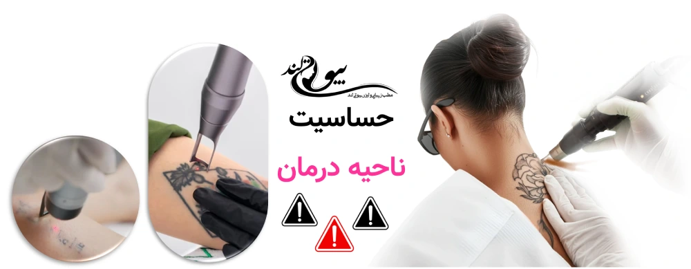 پاک کردن تاتوهای قدیمی و رنگی حساسیت ناحیه درمان